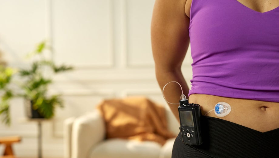 Person wearing an insulin pump with an infusion set attached to the abdomen.